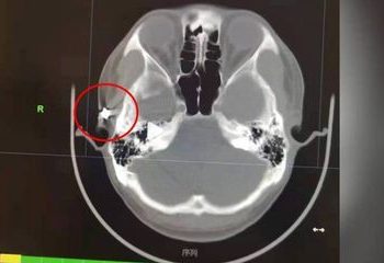 Sering Sakit Kepala, Rupanya Ada Peluru Bersarang di Tengkorak Selama 20 Tahun